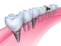 Dental Implants Bay City MI